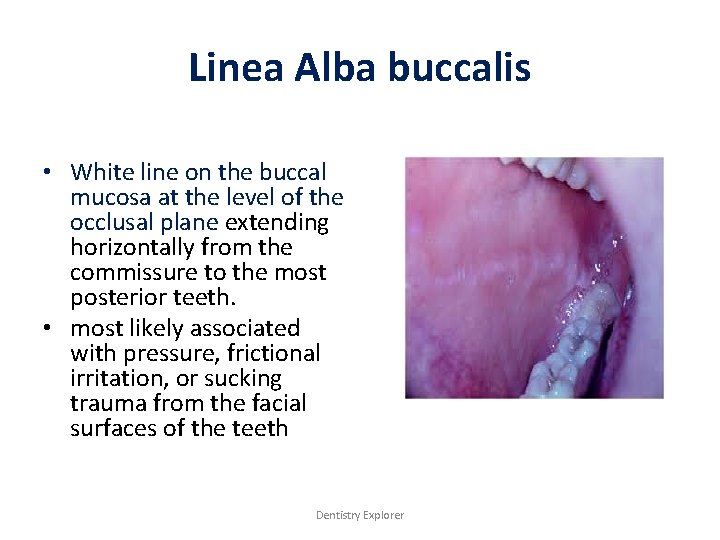 Linea Alba buccalis • White line on the buccal mucosa at the level of