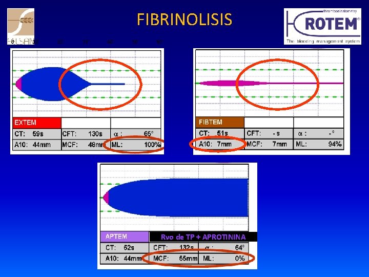 FIBRINOLISIS 0 10` 20` 30` 40` 50` 60` Rvo de TP + APROTININA 