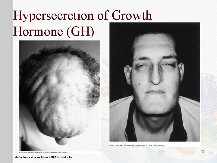 Hypersecretion of Growth Hormone (GH) 12 Mosby items and derived items © 2006 by