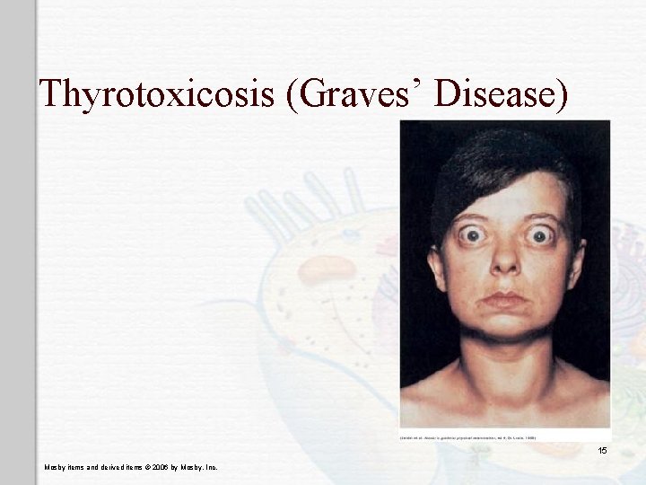 Thyrotoxicosis (Graves’ Disease) 15 Mosby items and derived items © 2006 by Mosby, Inc.