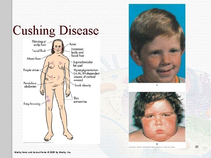 Cushing Disease 33 Mosby items and derived items © 2006 by Mosby, Inc. 