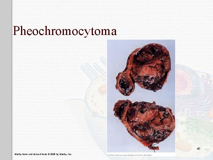 Pheochromocytoma 40 Mosby items and derived items © 2006 by Mosby, Inc. 