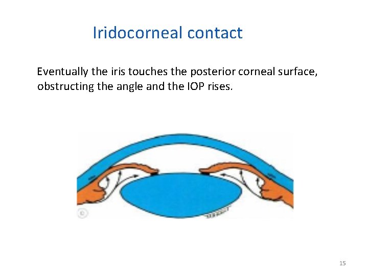 Iridocorneal contact Eventually the iris touches the posterior corneal surface, obstructing the angle and