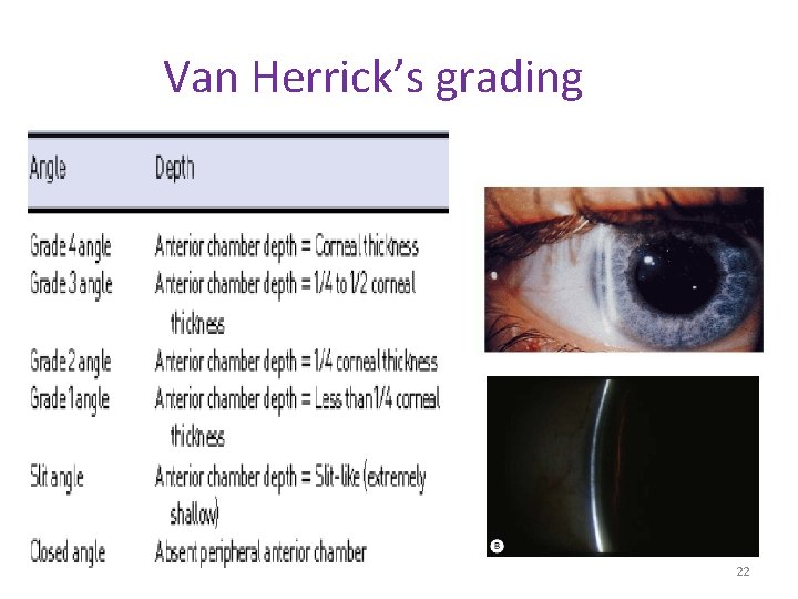 Van Herrick’s grading 22 