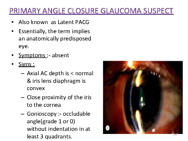 PRIMARY ANGLE CLOSURE GLAUCOMA SUSPECT • Also known as Latent PACG • Essentially, the