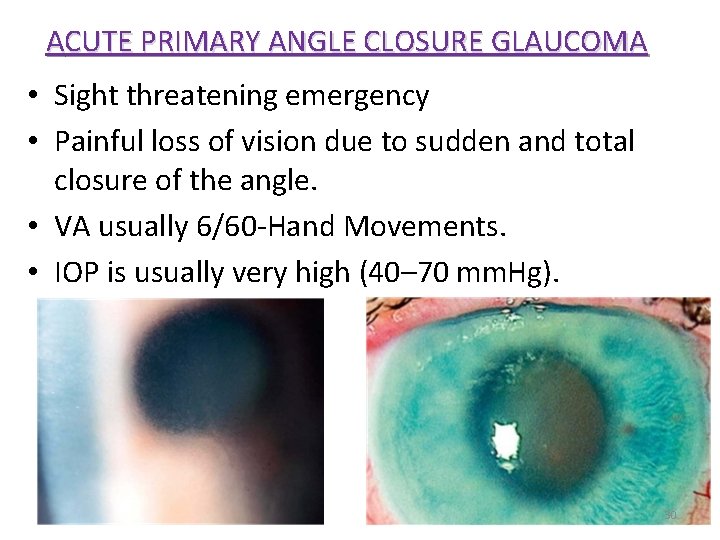 ACUTE PRIMARY ANGLE CLOSURE GLAUCOMA • Sight threatening emergency • Painful loss of vision ACUTE PRIMARY ANGLE CLOSURE GLAUCOMA • Sight threatening emergency • Painful loss of vision