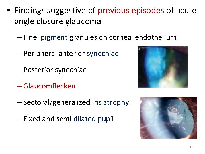  • Findings suggestive of previous episodes of acute angle closure glaucoma – Fine