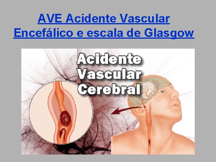 AVE Acidente Vascular Encefálico e escala de Glasgow 