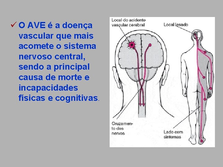ü O AVE é a doença vascular que mais acomete o sistema nervoso central,