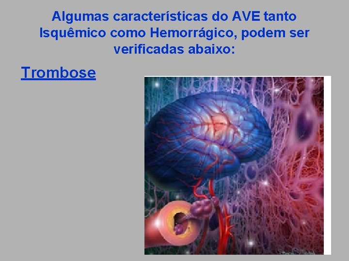 Algumas características do AVE tanto Isquêmico como Hemorrágico, podem ser verificadas abaixo: Trombose 