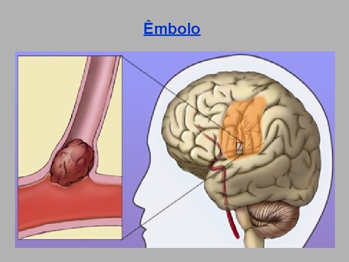 Êmbolo 