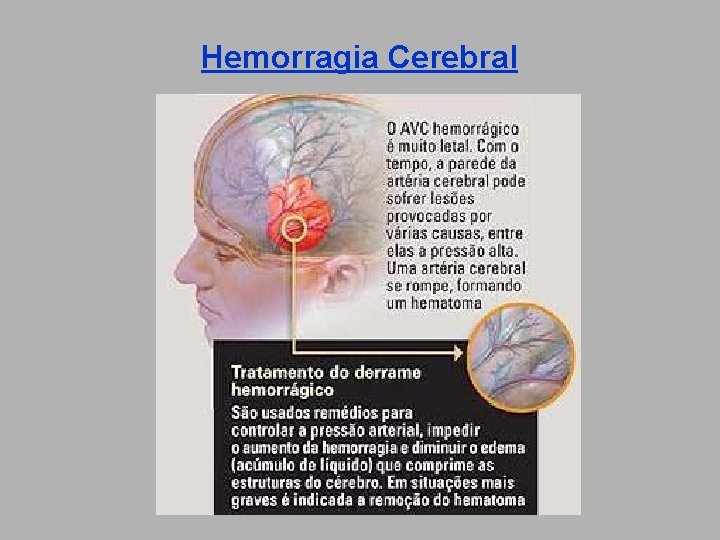 Hemorragia Cerebral 