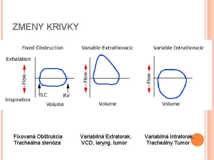 ZMENY KRIVKY Fixovaná Obštrukcia Variabilná Extratorak. Variabilná Intratorak. Tracheálna stenóza VCD, laryng. tumor Tracheálny