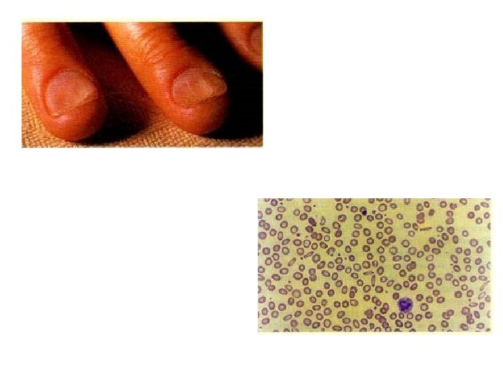 Koilonychia in a male patient with severe iron deficiency anaemia Iron deficiency anaemia. Peripheral