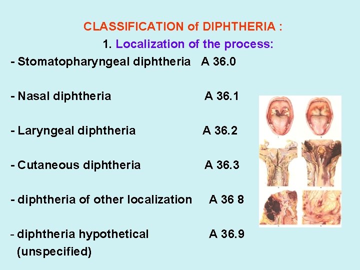 CLASSIFICATION of DIPHTHERIA : 1. Localization of the process: - Stomatopharyngeal diphtheria A 36.