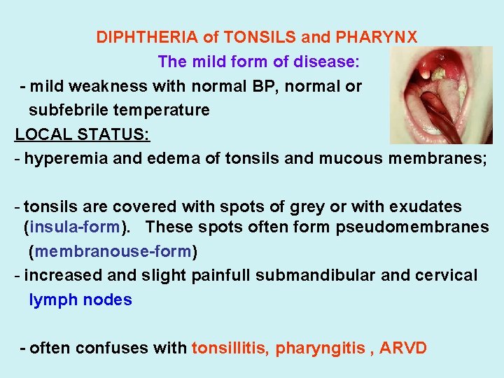 DIPHTHERIA of TONSILS and PHARYNX The mild form of disease: - mild weakness with