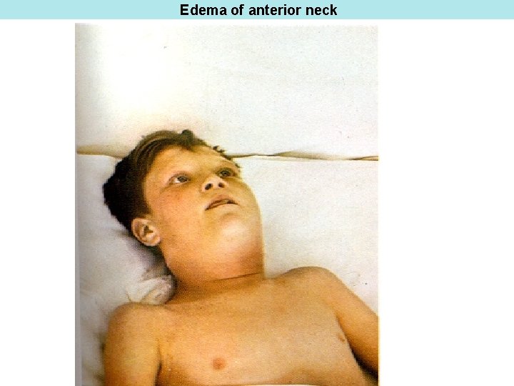 Edema of anterior neck 