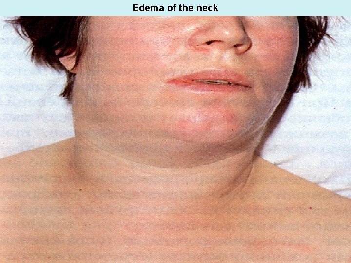 Edema of the neck 