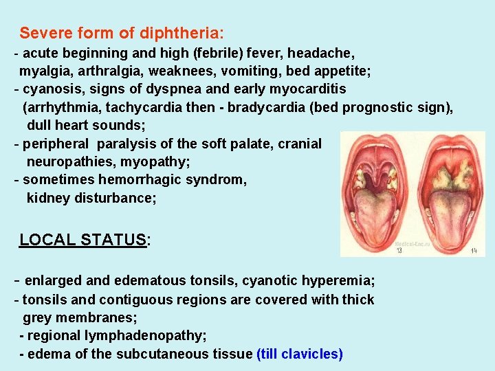 Severe form of diphtheria: - acute beginning and high (febrile) fever, headache, myalgia, arthralgia,