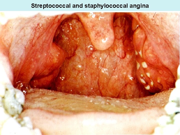 Streptococcal and staphylococcal angina 