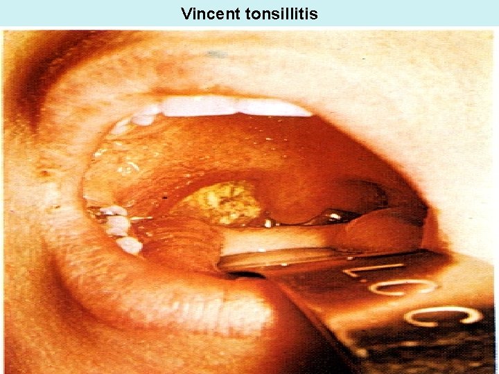 Vincent tonsillitis 