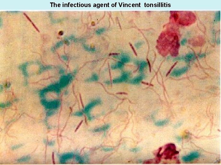 The infectious agent of Vincent tonsillitis 