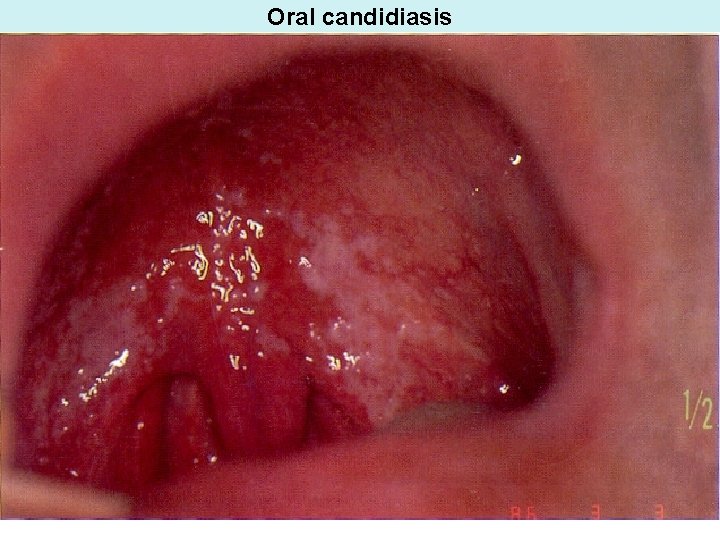 Oral candidiasis 