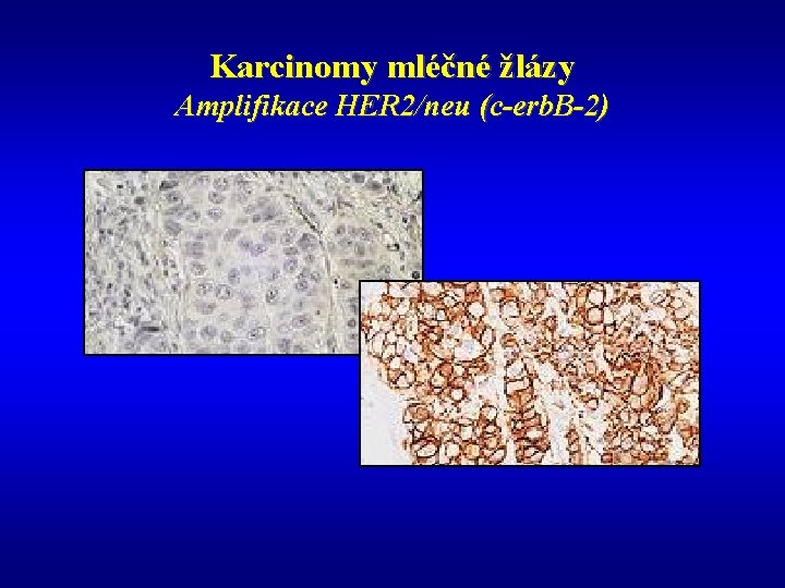 Karcinomy mléčné žlázy Amplifikace HER 2/neu (c-erb. B-2) 