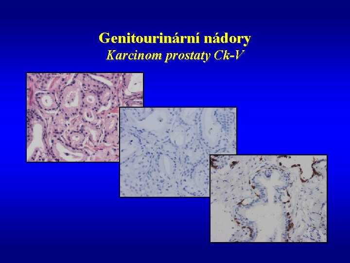Genitourinární nádory Karcinom prostaty Ck-V 
