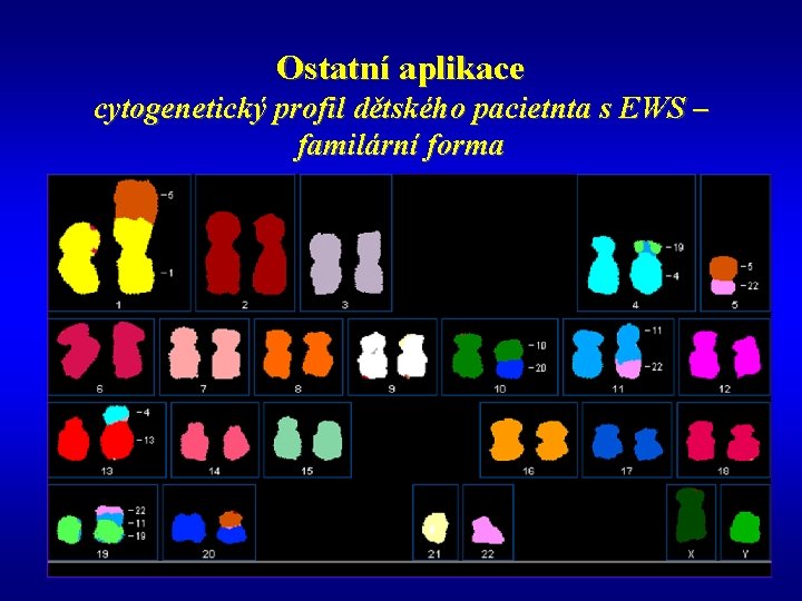 Ostatní aplikace cytogenetický profil dětského pacietnta s EWS – familární forma 