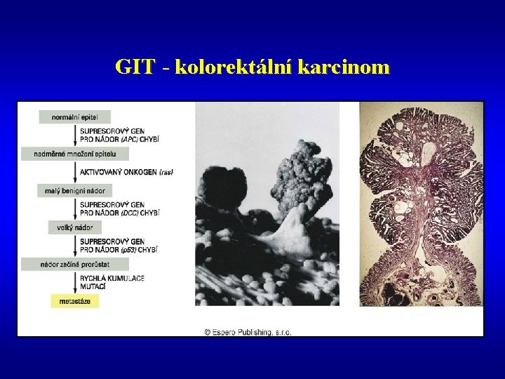 GIT - kolorektální karcinom 