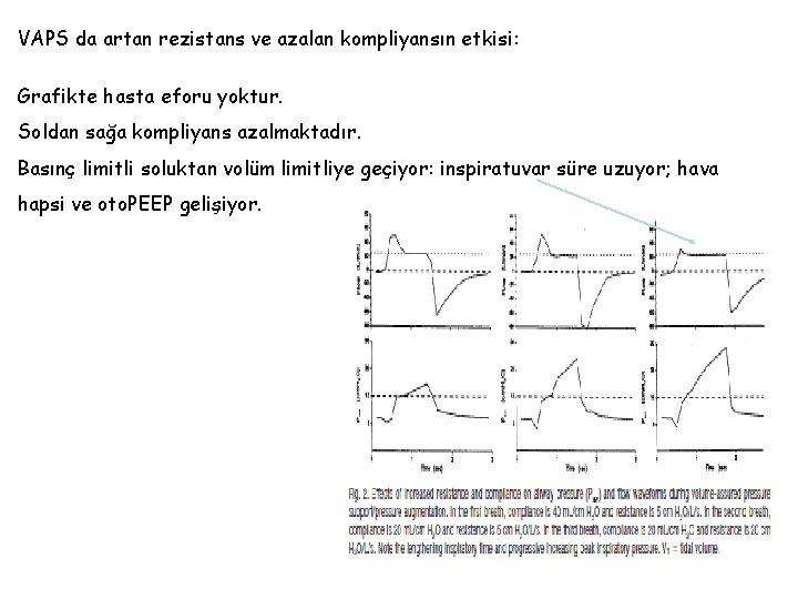 VAPS da artan rezistans ve azalan kompliyansın etkisi: Grafikte hasta eforu yoktur. Soldan sağa