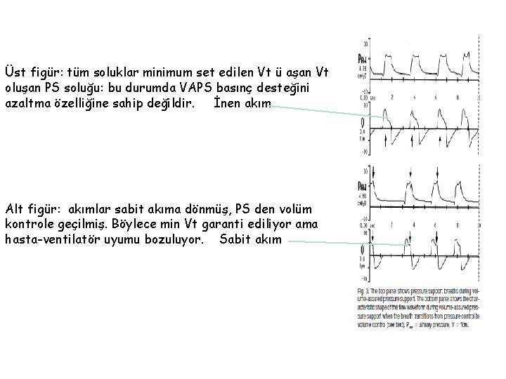 Üst figür: tüm soluklar minimum set edilen Vt ü aşan Vt oluşan PS soluğu: