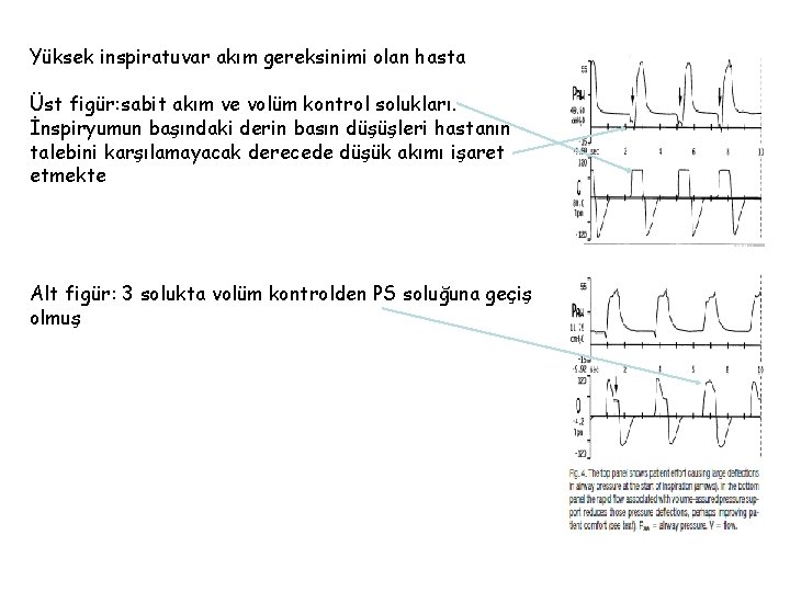 Yüksek inspiratuvar akım gereksinimi olan hasta Üst figür: sabit akım ve volüm kontrol solukları.