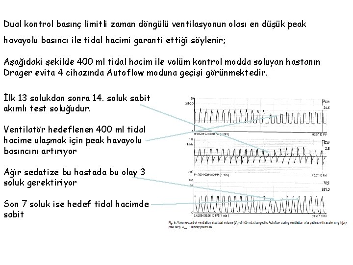 Dual kontrol basınç limitli zaman döngülü ventilasyonun olası en düşük peak havayolu basıncı ile