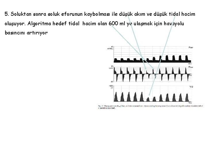 5. Soluktan sonra soluk eforunun kaybolması ile düşük akım ve düşük tidal hacim oluşuyor.