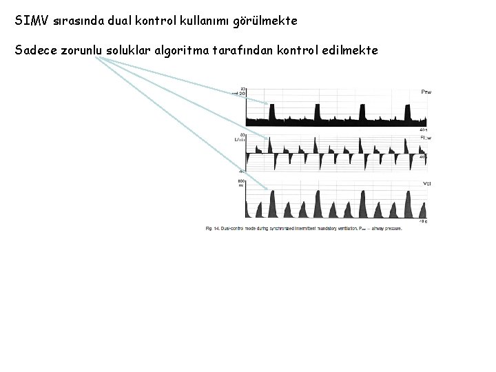 SIMV sırasında dual kontrol kullanımı görülmekte Sadece zorunlu soluklar algoritma tarafından kontrol edilmekte 