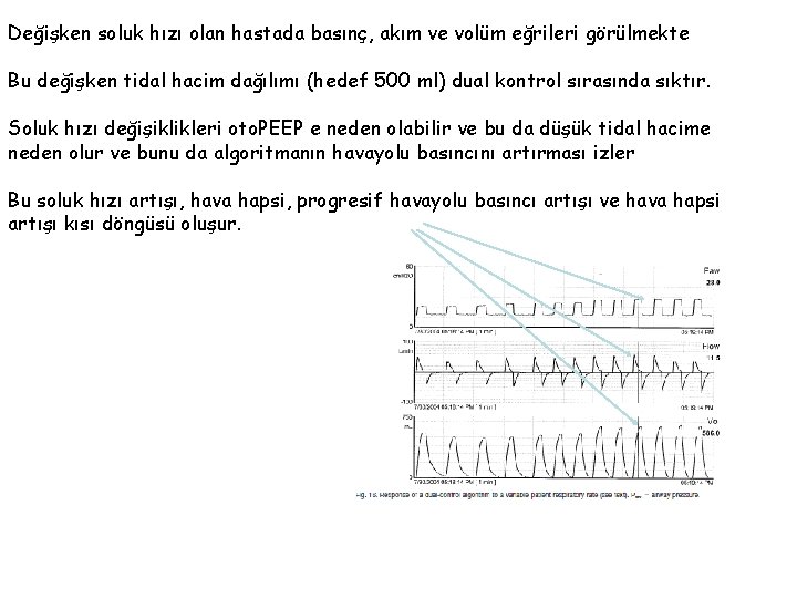 Değişken soluk hızı olan hastada basınç, akım ve volüm eğrileri görülmekte Bu değişken tidal