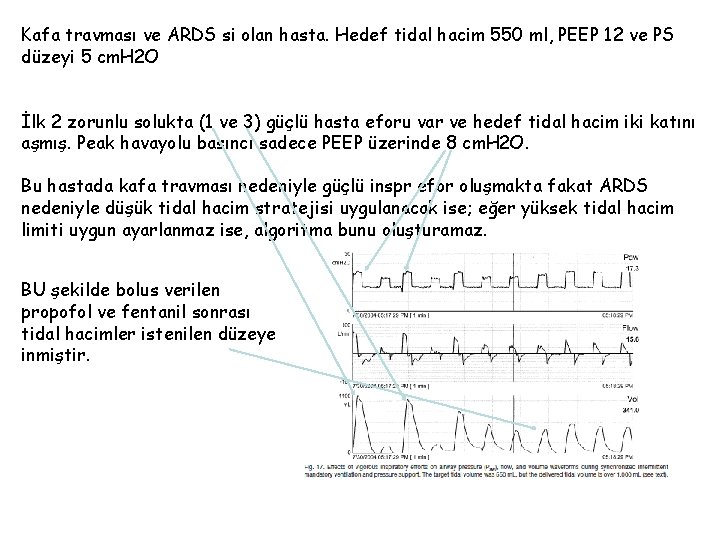 Kafa travması ve ARDS si olan hasta. Hedef tidal hacim 550 ml, PEEP 12