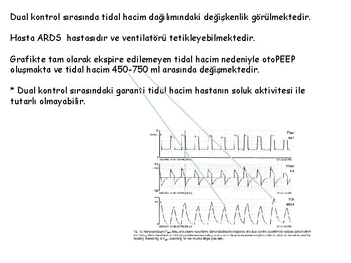 Dual kontrol sırasında tidal hacim dağılımındaki değişkenlik görülmektedir. Hasta ARDS hastasıdır ve ventilatörü tetikleyebilmektedir.