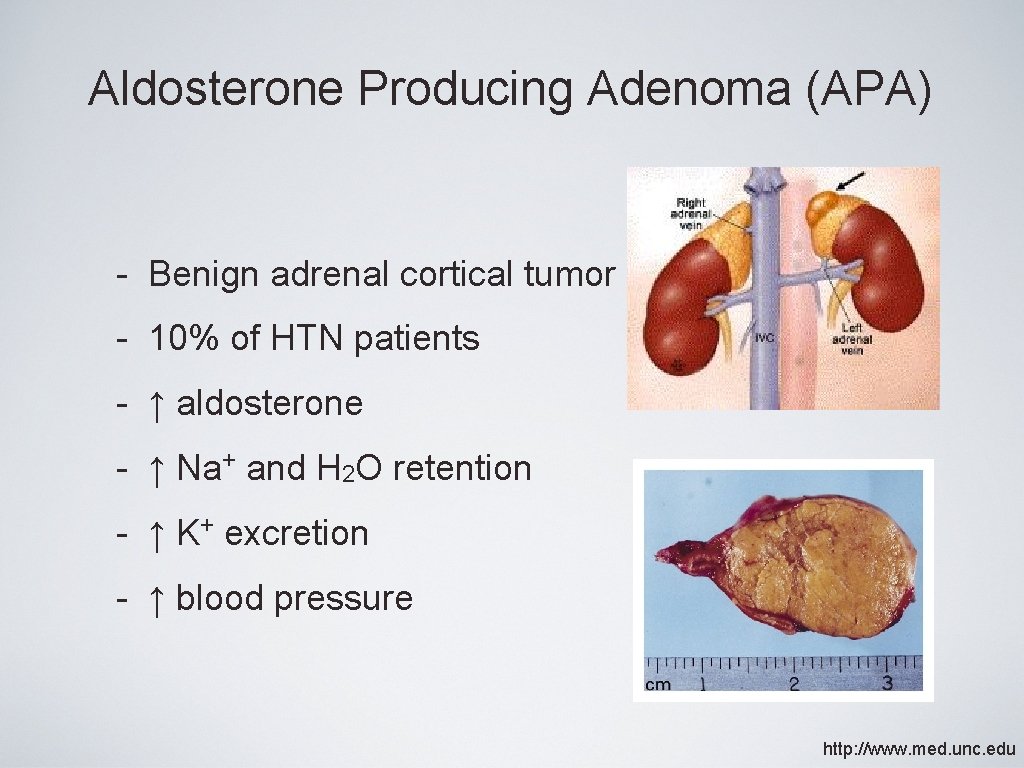 Aldosterone Producing Adenoma (APA) - Benign adrenal cortical tumor - 10% of HTN patients Aldosterone Producing Adenoma (APA) - Benign adrenal cortical tumor - 10% of HTN patients