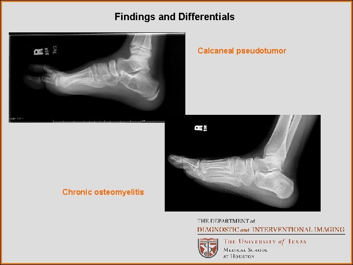 Findings and Differentials Calcaneal pseudotumor Chronic osteomyelitis 