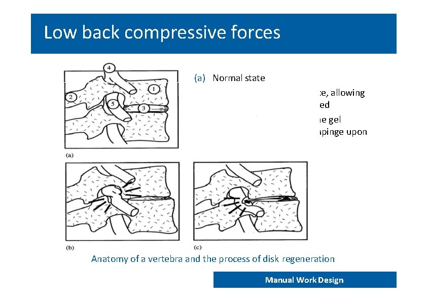 Low back compressive forces (a) Normal state (b) Narrowing of the disk space, allowing