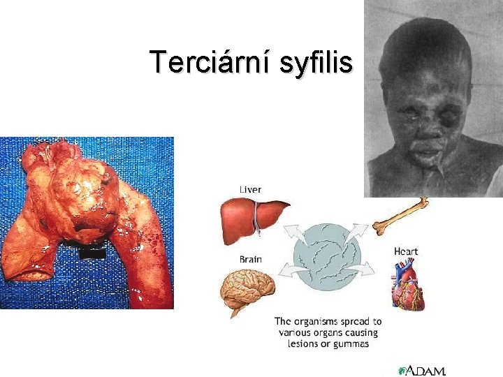 Terciární syfilis 