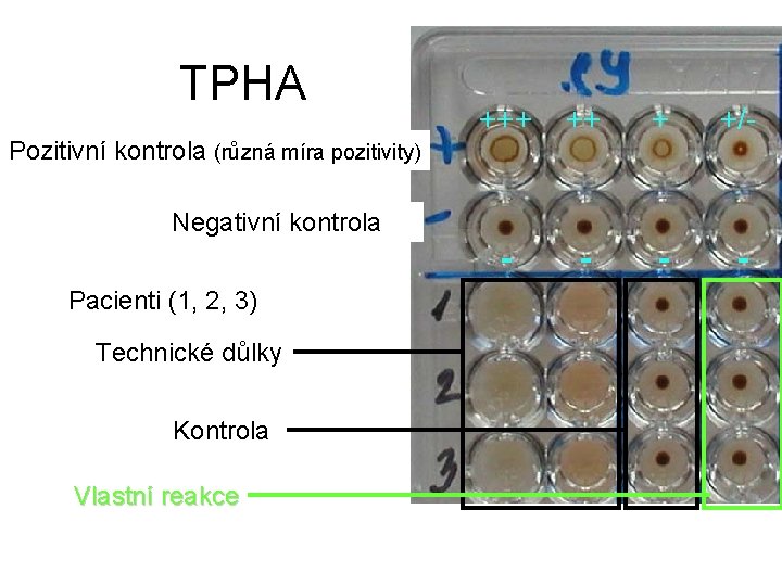TPHA Pozitivní kontrola (různá míra pozitivity) +++ ++ + +/- Negativní kontrola Pacienti (1,