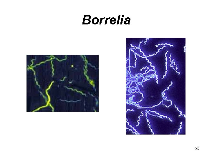 Borrelia 65 