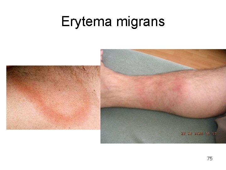 Erytema migrans 75 