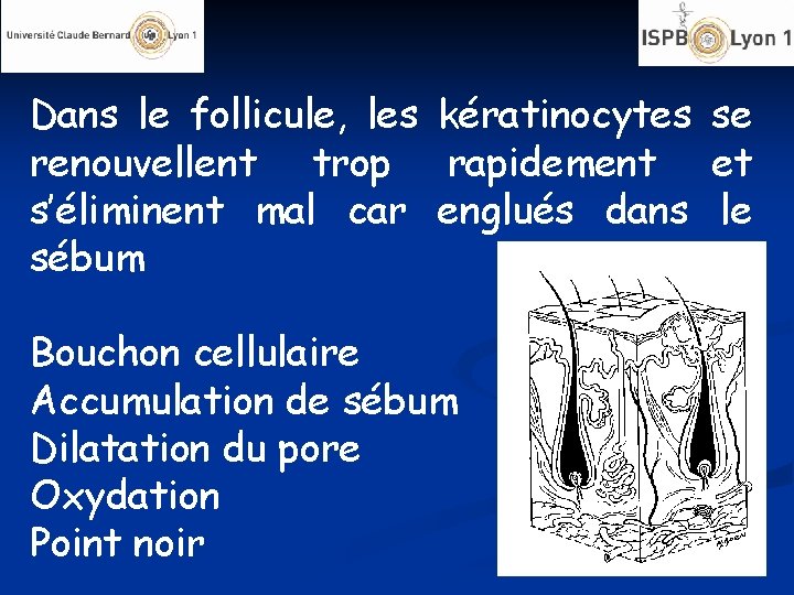 Dans le follicule, les kératinocytes se renouvellent trop rapidement et s’éliminent mal car englués