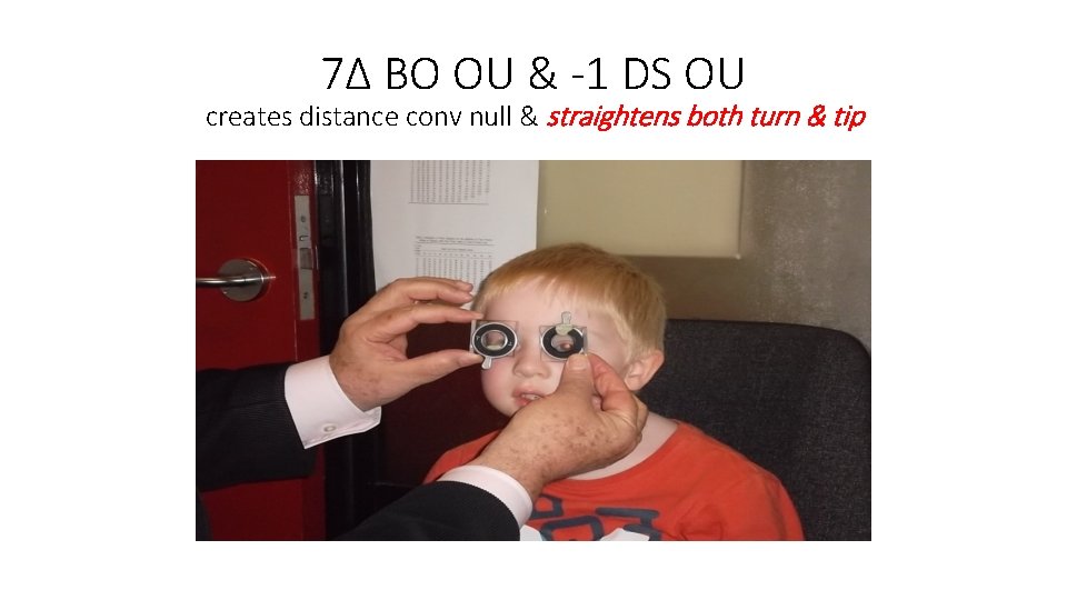 7Δ BO OU & -1 DS OU creates distance conv null & straightens both