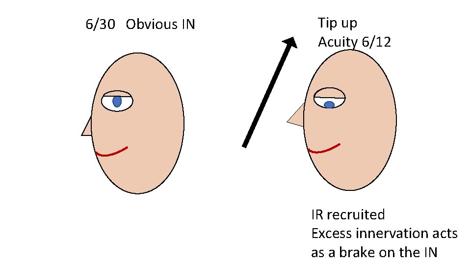 6/30 Obvious IN Tip up Acuity 6/12 IR recruited Excess innervation acts as a